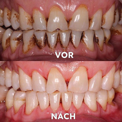 ✅Seurico™ Zahnfleischreparatur & Mundgesundheits-Pulver (CE-zertifiziert für Parodontitis, Mundgeschwüre und Zahnfleischrückgang)