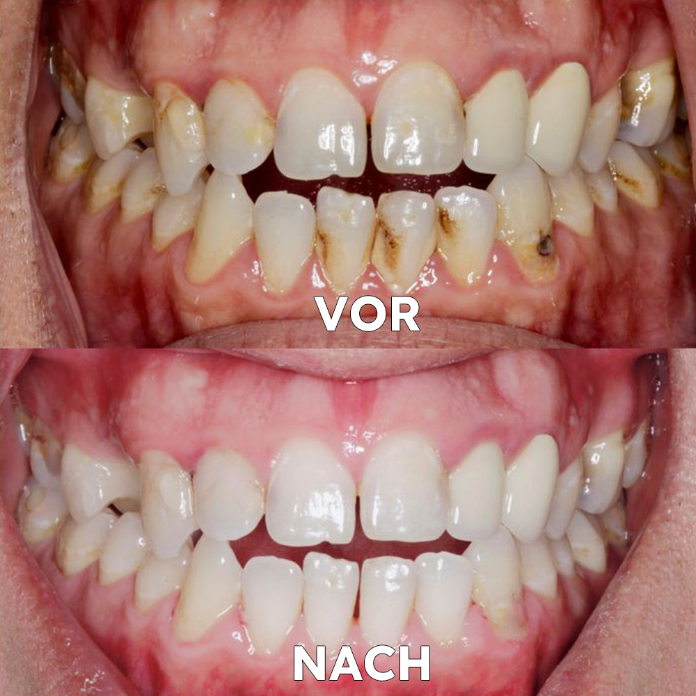 ✅Seurico™ Zahnfleischreparatur & Mundgesundheits-Pulver (CE-zertifiziert für Parodontitis, Mundgeschwüre und Zahnfleischrückgang)