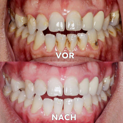✅Seurico™ Zahnfleischreparatur & Mundgesundheits-Pulver (CE-zertifiziert für Parodontitis, Mundgeschwüre und Zahnfleischrückgang)