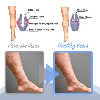 🔥Varellix™ Sale Varicose Veins Relief Spray – Herbal Treatment For Spider & Varicose Veins - 94% Of Users See Visible Results Within 1 To 2 Weeks!