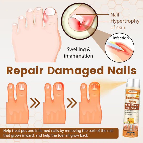 VanaSculpt® Bienenvergiftung Nagelpilz Spray