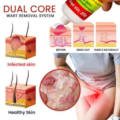 Gynovia® Female Genital Wart Remover Cream