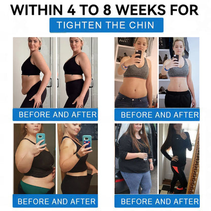 🔥 Best Seller-TirzaForm® SMGT-GLP-1 𝐓𝐢𝐫𝐳𝐞𝐩𝐚𝐭𝐢𝐝𝐞 & 𝐂𝐨𝐥𝐥𝐚𝐠𝐞𝐧 𝐍𝐚𝐧𝐨 𝐌𝐢𝐜𝐫𝐨𝐧𝐞𝐞𝐝𝐥𝐞 𝐖𝐞𝐢𝐠𝐡𝐭 𝐋𝐨𝐬𝐬 𝐏𝐚𝐭𝐜𝐡